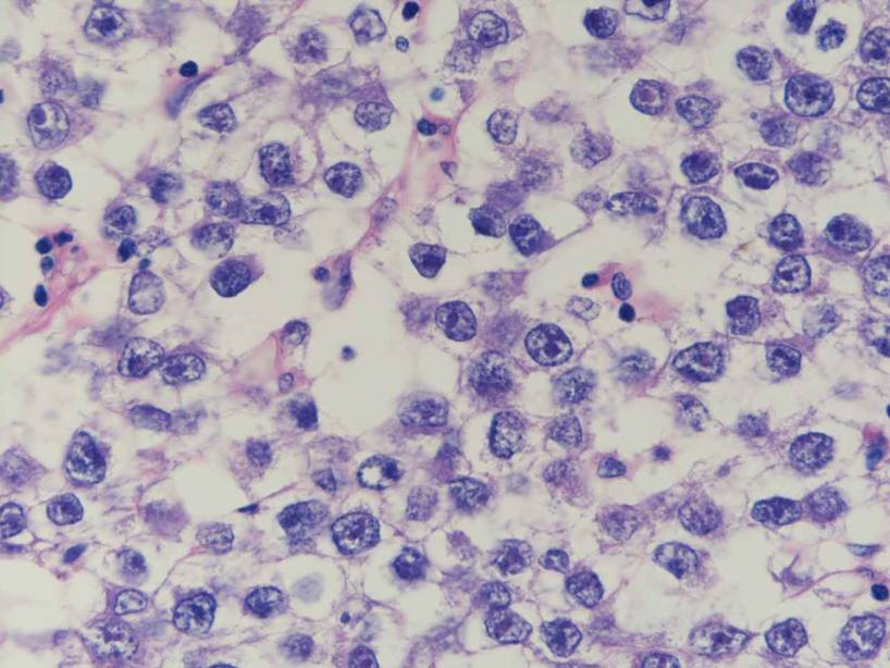 腫瘍 胚 細胞 Germ Cell