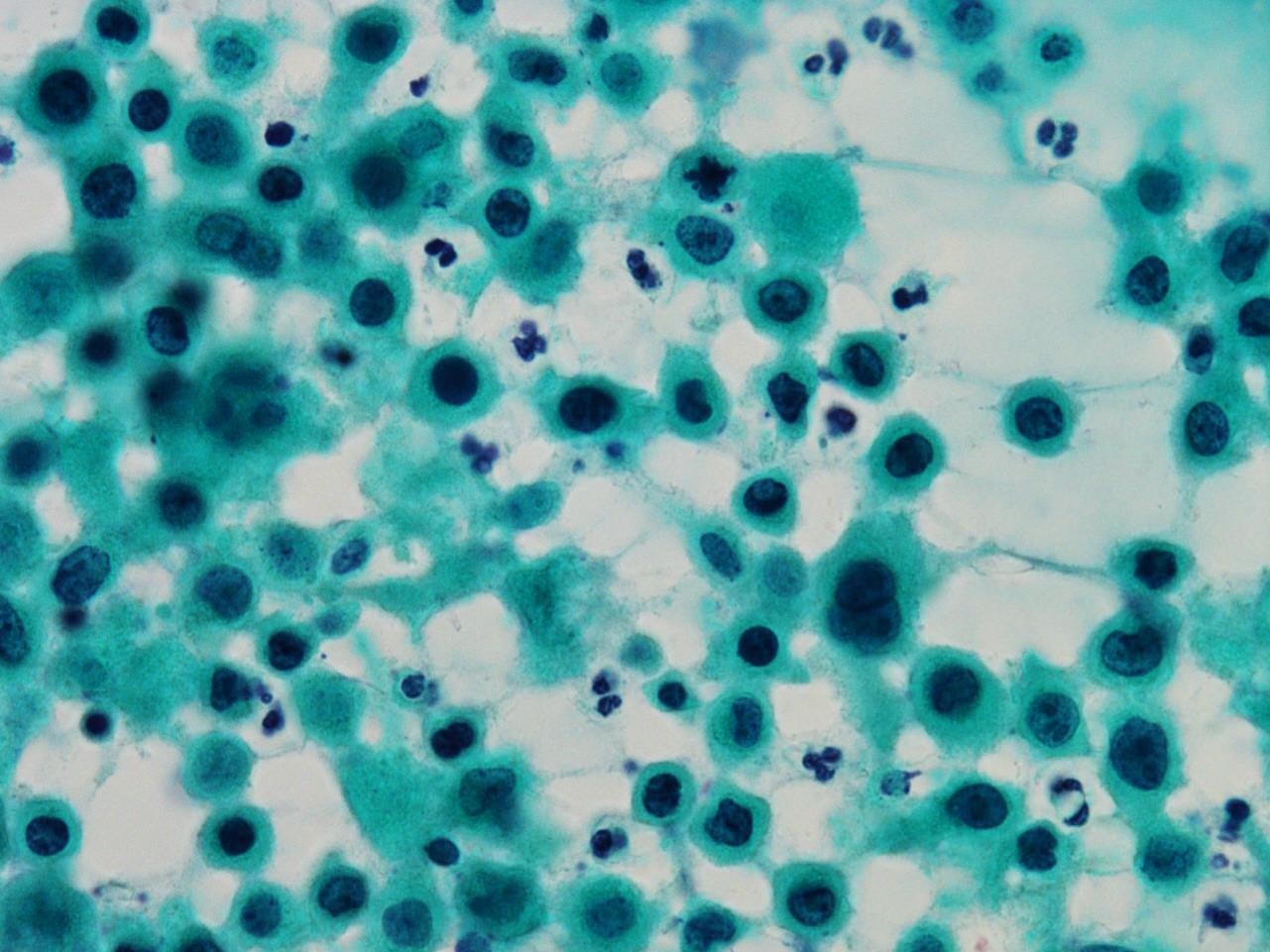 リンパ腫 b 細胞 性 大 びまん 型 細胞