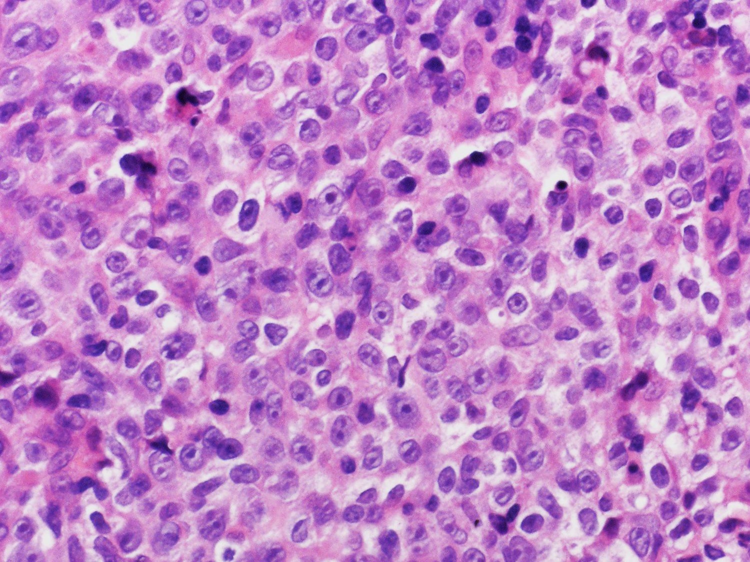 リンパ腫 b 細胞 性 大 びまん 型 細胞