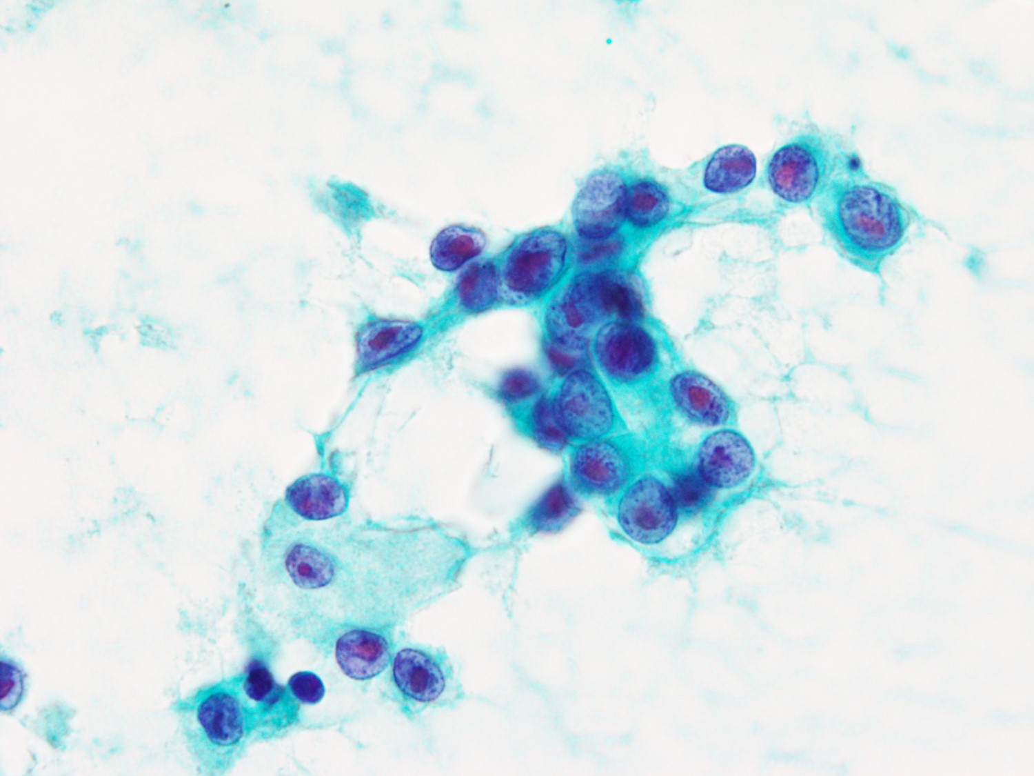 EUSFNAで経験した膵腺房細胞癌の一例 日本臨床細胞学会東海連合会日本臨床細胞学会東海連合会