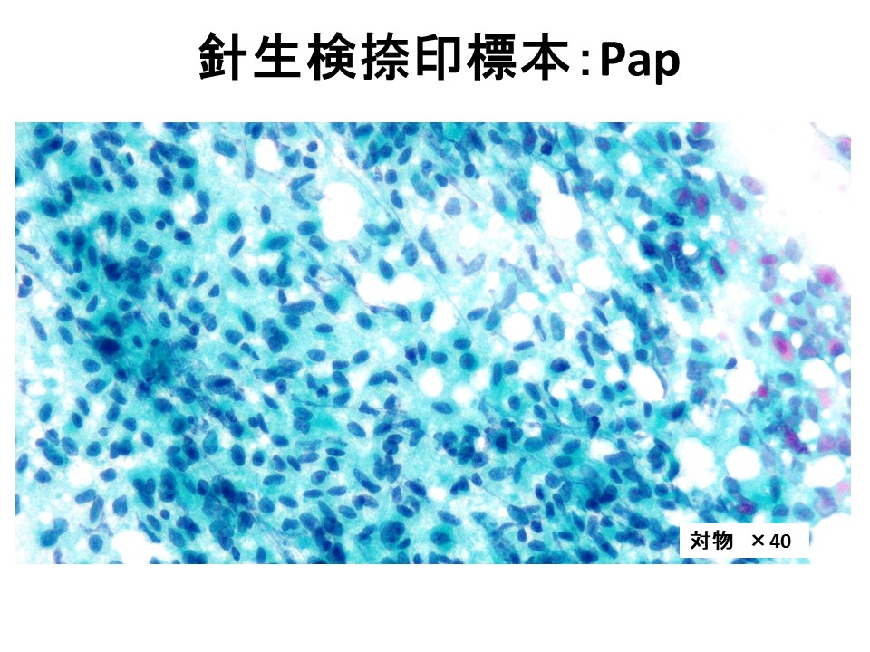 浸潤性乳管癌（with spindle cell carcinoma component）の一例 | 日本臨床細胞学会東海連合会